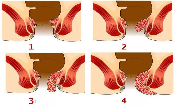 ako vyzerajú hemoroidy v rôznych štádiách