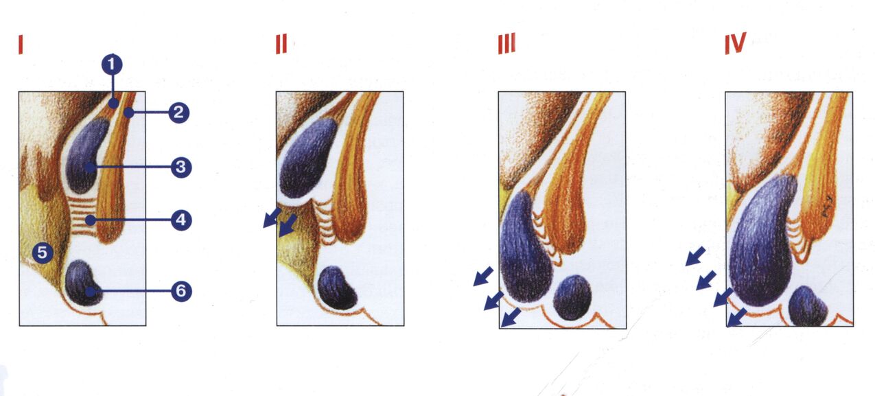 štádia vývoja hemoroidov